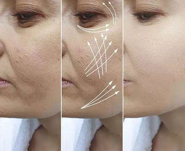 Fibroblast Skin Tightening Boca Raton