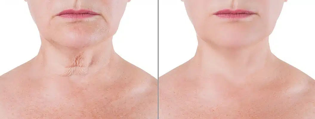 Fibroblast Skin Tightening Boca Raton