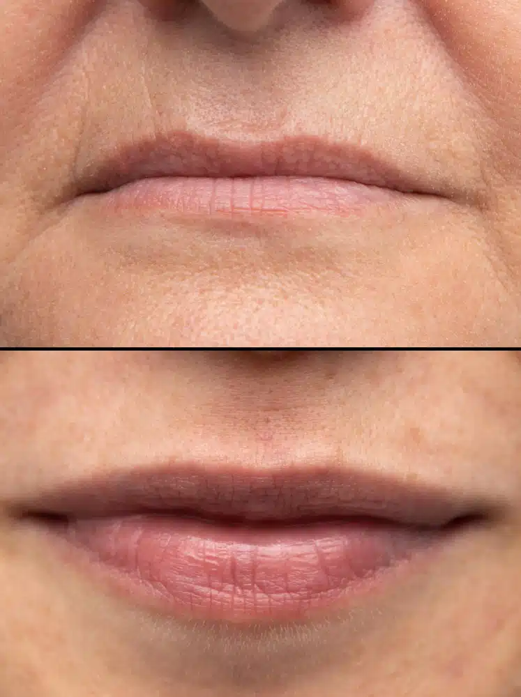 Benefits of Double Lip Fix Boca Raton