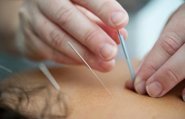 What Is Acupuncture? See If The Treatment Is Right For You!