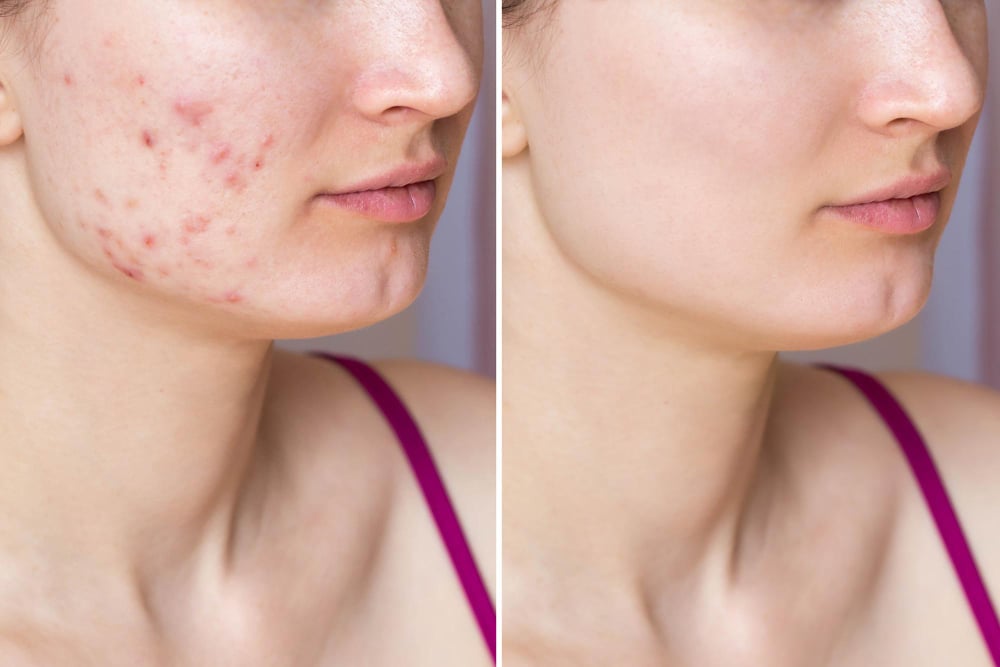 How Electrolysis Can Improve Your Skin Skin Apeel